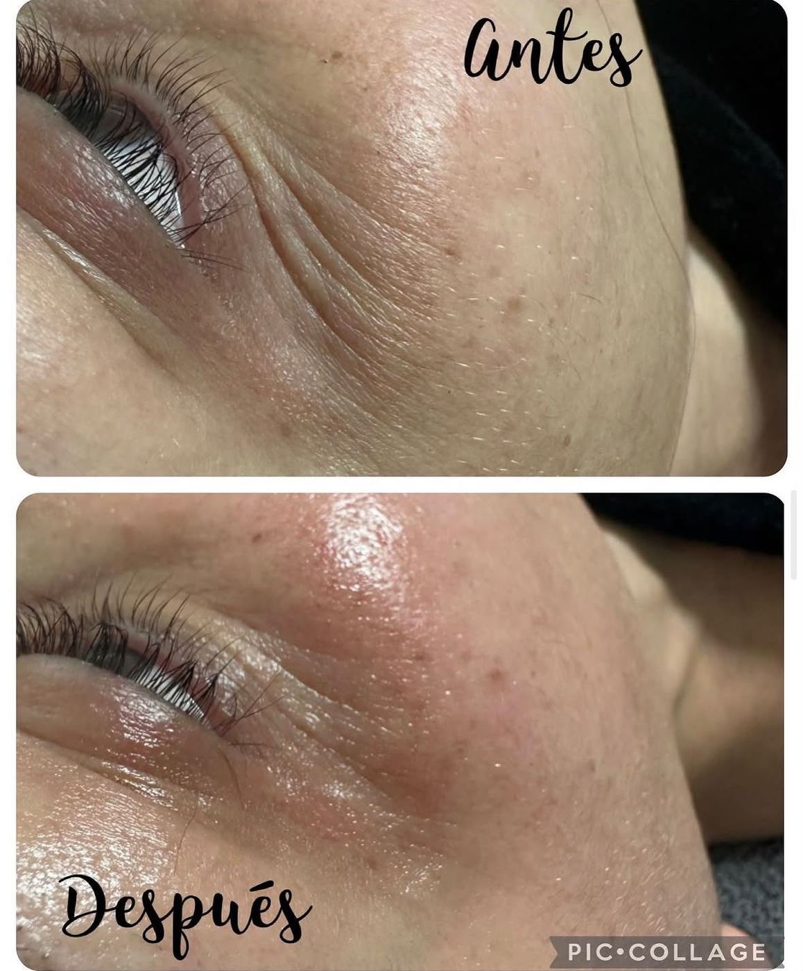 Antes y después de un tratamiento en el Centro de Estética Milenium