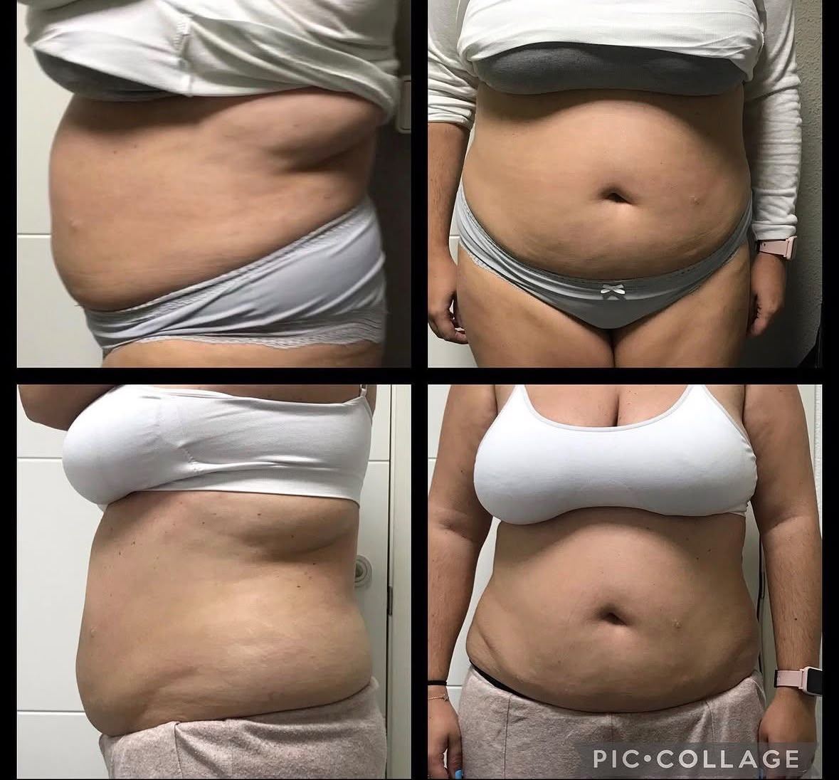 Antes y después de un tratamiento en el Centro de Estética Milenium
